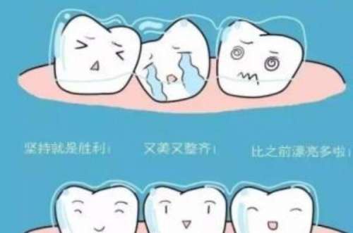 种植牙搭桥方案有几种