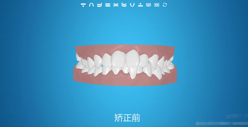 牙齿矫正垫高后多久能正常吃饭—重磅消息牙齿矫正垫高后