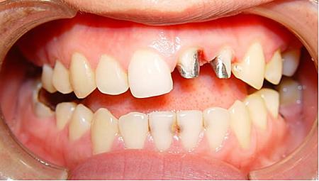 根管治疗桩冠修复步骤