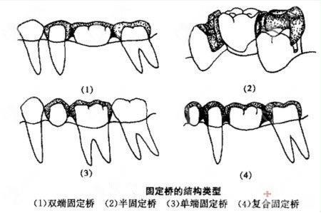 口腔桥体分类图片图片