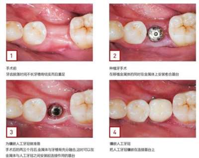 镶牙的全部过程图片
