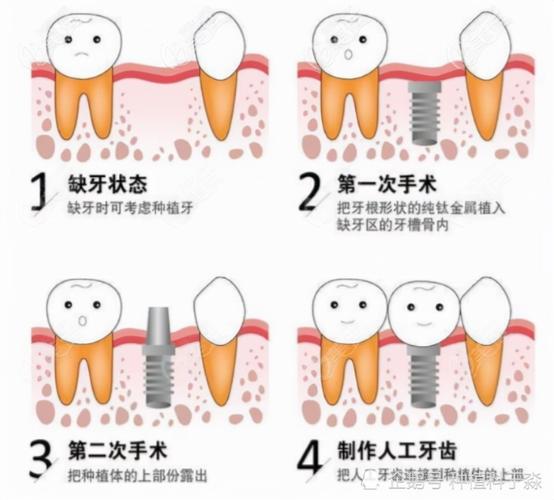 假牙牙龈萎缩怎么治疗最有效