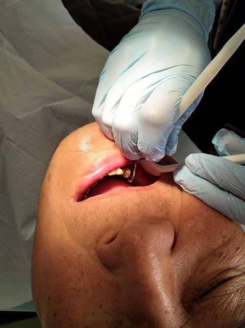 轻松拔除断牙残根也不是问题