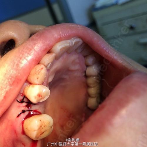 轻松拔除断牙残根也不是问题