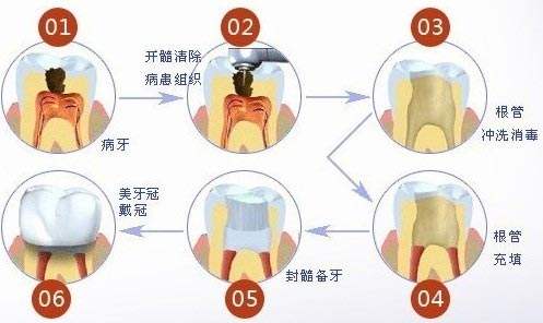 保牙髓治疗后牙髓疼怎么办